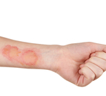 צלקת היפרטרופית - תמונת המחשה